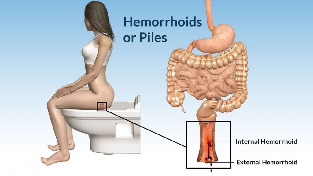 Piles: Symptoms, Causes, Treatment and Natural Home remedies.