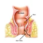 best hospital for fistula treatment in bangalore 85x85