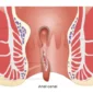 fissure treatment 85x85