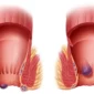 Anorectal Fistula vs. Hemorrhoids_ Whats the Difference_ 85x85
