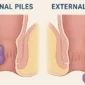 How to Know If You Have Internal or External Piles 85x85