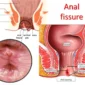 en_anal fissure 85x85