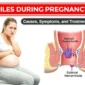 Piles During Pregnancy Causes Symptoms and Treatment.jpeg 85x85