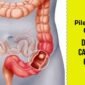 Does Piles cause Colon Cancer 1 85x85